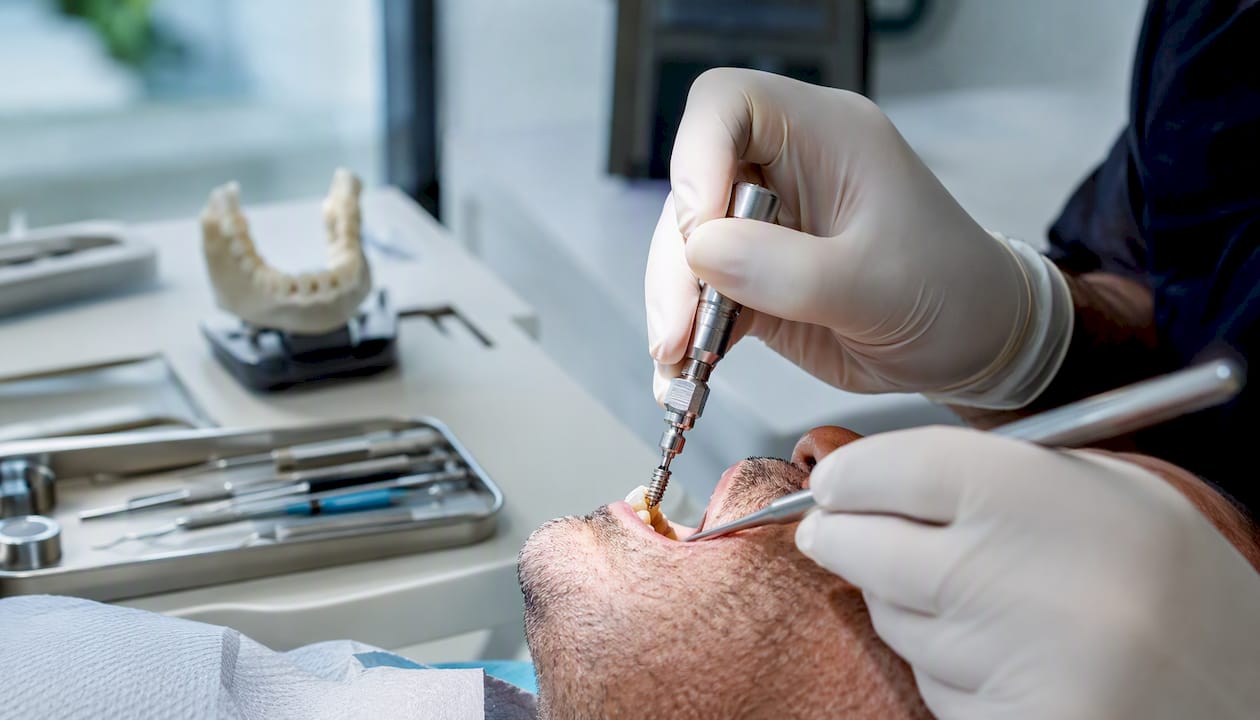 Zobozdravnik namešča nastavek za zobni implantat.