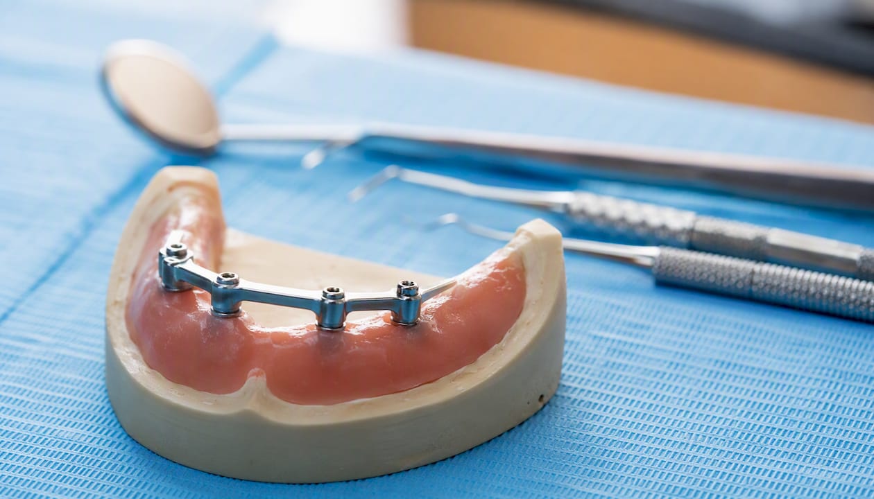 Prikaz zobne proteze na implantatih z nosilno prečko