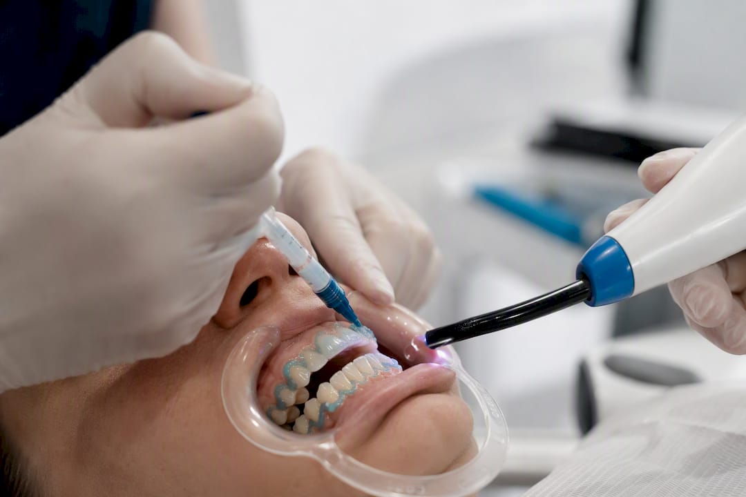 Prikaz nanašanja zobnega lasernega belilnega gela od blizu