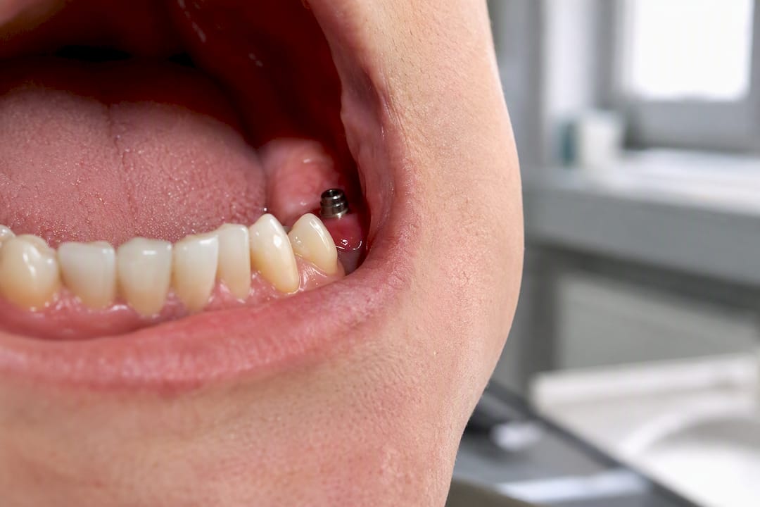 Otekle dlesni okoli mesta vstavitve zobnega implantata